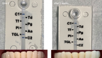 使用PARX塑料技术治疗3周后口腔内不再发现牙周炎细菌